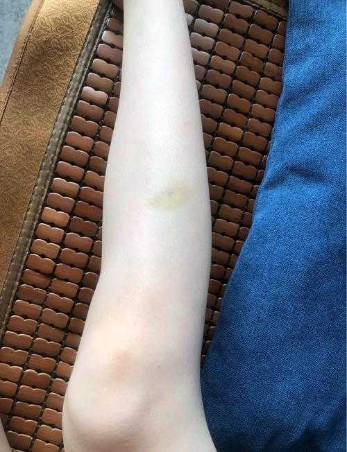 皮肤淤青快速消除的8个有效方法